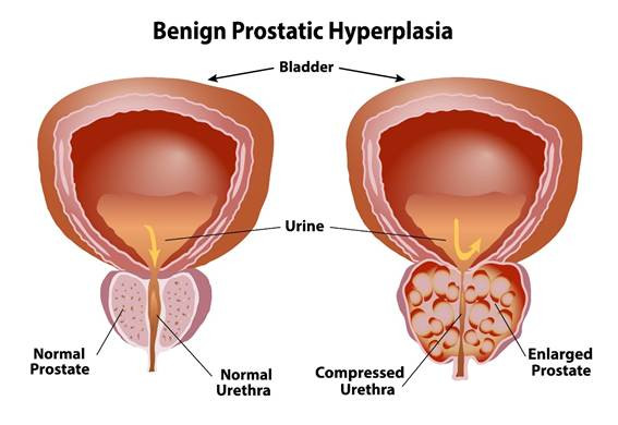 Imagen de benign prostatic hyperplasia vs a normal prostate